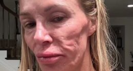 Brandi Glanville has revealed that her facial disfigurement was actually the result of ruptured breast implants that led to an infection