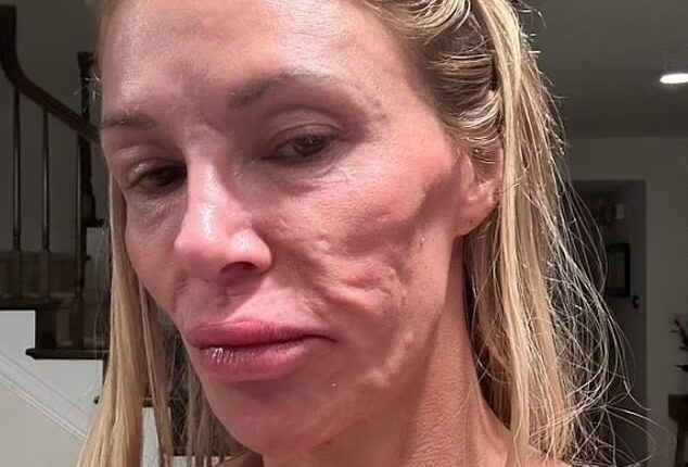 Brandi Glanville has revealed that her facial disfigurement was actually the result of ruptured breast implants that led to an infection