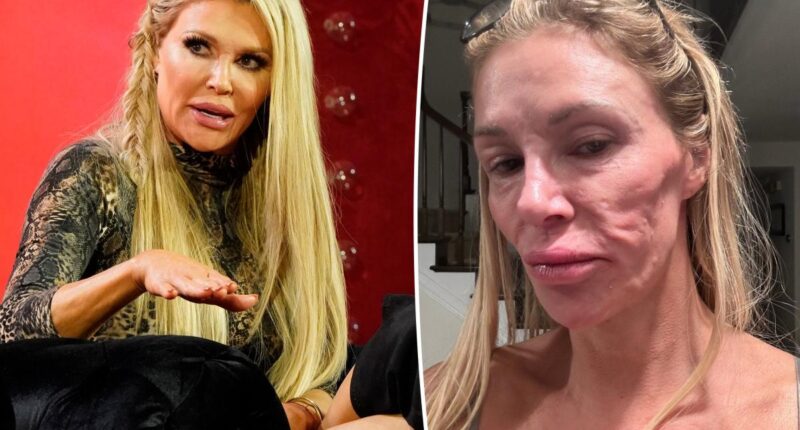 Brandi Glanville shares exorbitant cost of trying to figure out facial parasite mystery