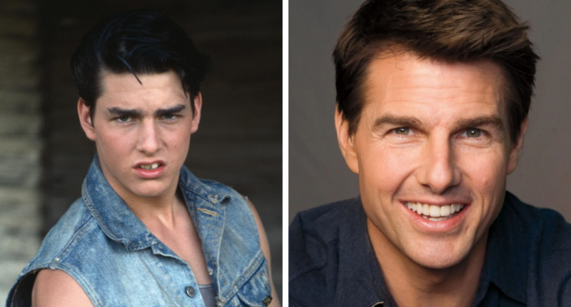 From Gaps To Glam: 12 Celebrity Dental Implant Makeovers You Won’t Believe