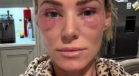 After undergoing CO2 laser resurfacing skin treatment around her eyes, Sarah Lindsay woke up on Christmas Eve barely able to see. Her eyes were swollen, red and so puffy she looked like she¿d been in the ring with a heavyweight boxer