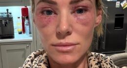 After undergoing CO2 laser resurfacing skin treatment around her eyes, Sarah Lindsay woke up on Christmas Eve barely able to see. Her eyes were swollen, red and so puffy she looked like she¿d been in the ring with a heavyweight boxer