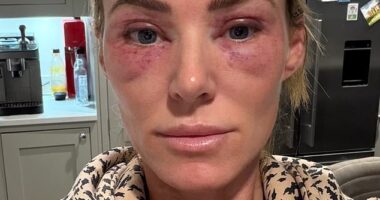 After undergoing CO2 laser resurfacing skin treatment around her eyes, Sarah Lindsay woke up on Christmas Eve barely able to see. Her eyes were swollen, red and so puffy she looked like she¿d been in the ring with a heavyweight boxer