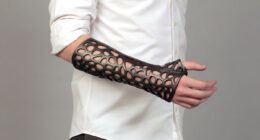 3D-Printed Plastic Cast Looks Awesome And Uses Ultrasound To Heal Broken Bones Faster