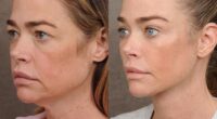 Actress Denise Richards, 55, showed off the stunning results from her recent facelift