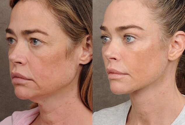 Actress Denise Richards, 55, showed off the stunning results from her recent facelift