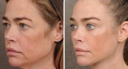 Denise Richards Reveals Dramatic Facelift Transformation In Before-And-After Photos