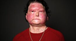 Joseph Dimeo remembers getting into his car after a long shift with little sleep. The next thing he knew, he was waking up three months later in a hospital, with 80 percent of his skin burned off