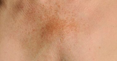 Pigmentation, fine lines or crepiness can particularly impact the décolletage