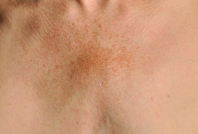 Pigmentation, fine lines or crepiness can particularly impact the décolletage