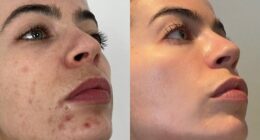 Ever since a boy poked fun at Francesca O'Reilly's acne at school, she has had a devil on her shoulder saying she wasn't good enough - but now her face is smooth and complexion bright