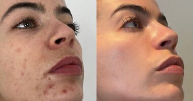 Ever since a boy poked fun at Francesca O'Reilly's acne at school, she has had a devil on her shoulder saying she wasn't good enough - but now her face is smooth and complexion bright