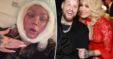 Jelly Roll's wife, Bunnie Xo, unveils gruesome aftermath of facelift