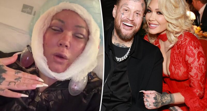 Jelly Roll's wife, Bunnie Xo, unveils gruesome aftermath of facelift