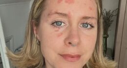 There’s no cure for psoriasis and no guaranteed treatment; 17 years on, my arms, legs and face are still speckled with red patches