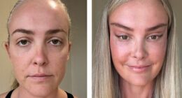 “Someone PAID For This”: People Go Wild Mocking Woman’s Before-And-After Cosmetic Procedure