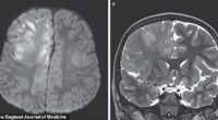 The above images show the child's brain nearly seven years after he was infected with measles. He died a year later of subacute sclerosing panencephalitis (SSPE)