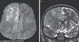 The above images show the child's brain nearly seven years after he was infected with measles. He died a year later of subacute sclerosing panencephalitis (SSPE)