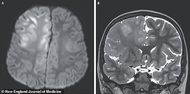 The above images show the child's brain nearly seven years after he was infected with measles. He died a year later of subacute sclerosing panencephalitis (SSPE)