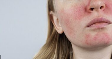 Many people with skin conditions such as eczema, psoriasis and rosacea will find that they flare up in winter
