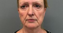 Ellen Palmer before her deep plane facelift, which was performed by Dr Yannis Alexandrides