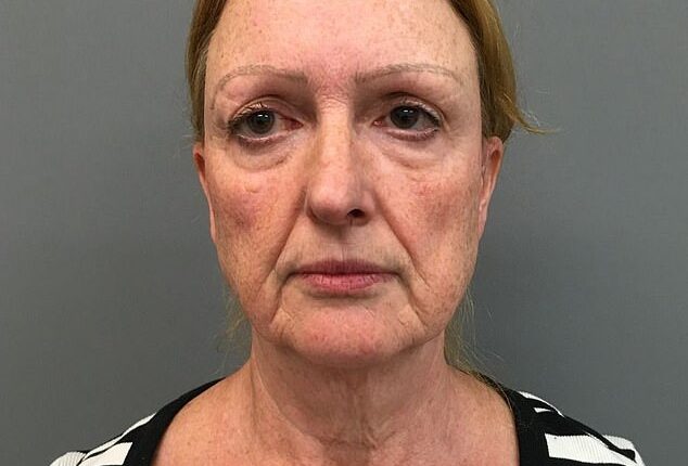 Ellen Palmer before her deep plane facelift, which was performed by Dr Yannis Alexandrides