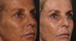 Ulrika Jonsson has proudly revealed new before and after shots after unveiling her youthful complexion; Pictured left before her six months of treatments, and right after