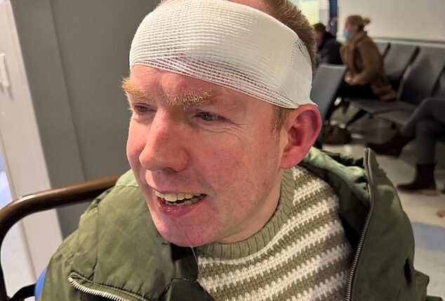 Britain's Got Talent winner Lost Voice Guy was rushed to hospital after he split his head open following a horror fall