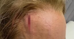 Carrie Bickmore, 45, has revealed she suffered a horrific injury to her head while on a break from work