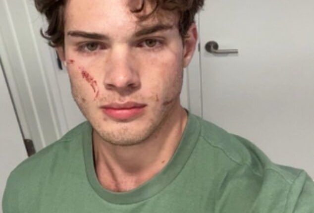 Clavicular has revealed that he is home after being rushed to the hospital following a suspected overdose amid an unsettling livestream that suddenly ended on Tuesday night