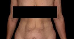 Zehra found she was struggling with excess skin after transformative weight loss