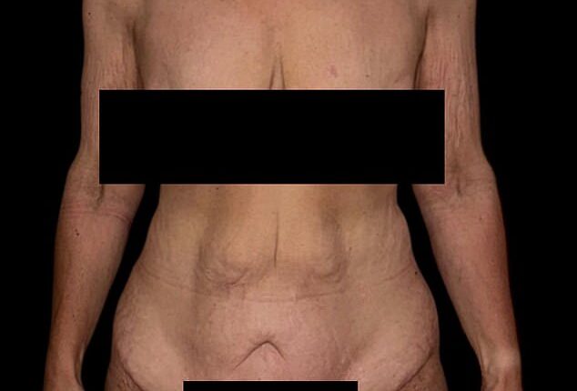 Zehra found she was struggling with excess skin after transformative weight loss