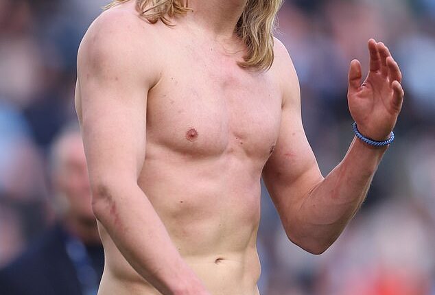 Haaland shows off his battle wounds after a physical tussle with Arsenal centre back Gabriel