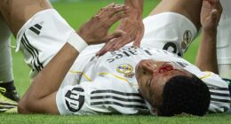 Kylian Mbappe was left bloodied after below struck in the face by an elbow against Girona