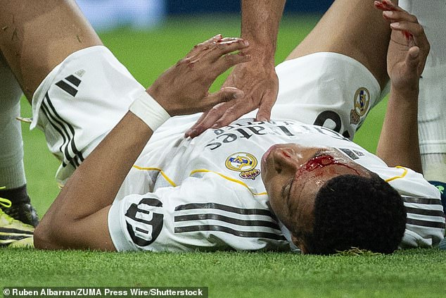 Kylian Mbappe was left bloodied after below struck in the face by an elbow against Girona