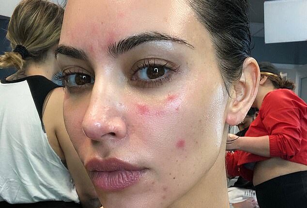 Reality television star Kim Kardashian revealed she had been diagnosed with psoriasis seven years ago