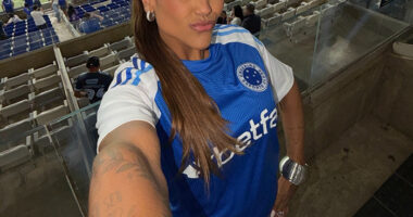 This Influencer Removed A Vein From Her Forehead Because It Bothered Her Aesthetically And Shared The Results