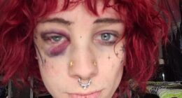 A trans woman was allegedly assaulted at a sober metal concert in Salt Lake City, Utah, on Sunday. She is pictured with a black eye