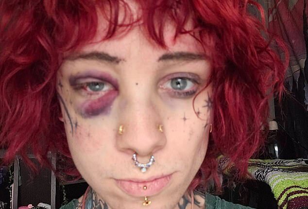 A trans woman was allegedly assaulted at a sober metal concert in Salt Lake City, Utah, on Sunday. She is pictured with a black eye