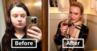Woman Shows Her Crazy Transformation, People Can’t Believe It: “Lip Fillers, Botox, Weight Loss”