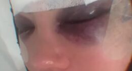 Yazmin Oukhellou revealed the painful results of her facelift on Thursday after jetting to Turkey - as she becomes the latest TOWIE star to go under the knife