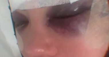 Yazmin Oukhellou revealed the painful results of her facelift on Thursday after jetting to Turkey - as she becomes the latest TOWIE star to go under the knife