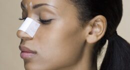 Nasal strips can work well