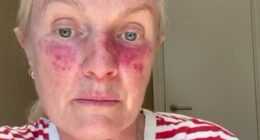 Lorraine's actinic keratosis had to be treated with a 'chemo-cream' called Tolak to destroy the cancerous cells - but it left her face red and in constant pain