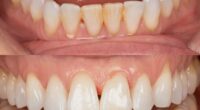 Rosie's teeth before and after her Airflow cleaning treatment, which removed tea and coffee staining