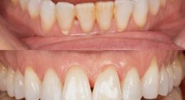 Rosie's teeth before and after her Airflow cleaning treatment, which removed tea and coffee staining