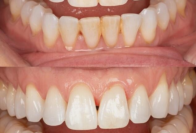 Rosie's teeth before and after her Airflow cleaning treatment, which removed tea and coffee staining