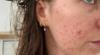 Having never suffered from acne before, the hormonal coil prompted a painful reaction from Lucy's skin
