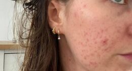 Having never suffered from acne before, the hormonal coil prompted a painful reaction from Lucy's skin