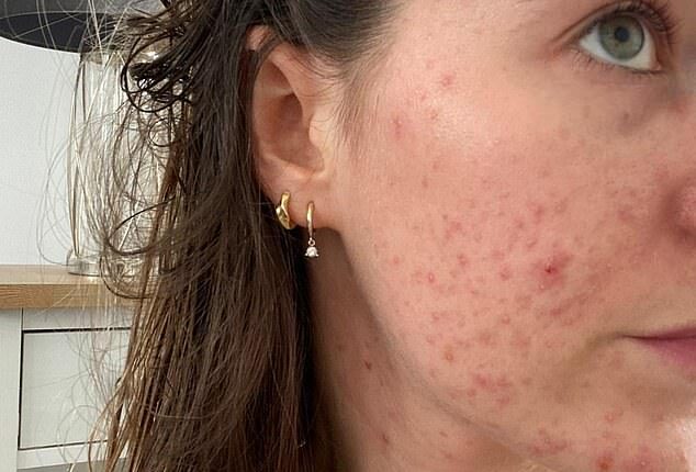 Having never suffered from acne before, the hormonal coil prompted a painful reaction from Lucy's skin